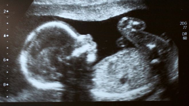 ultrassom de bebê
