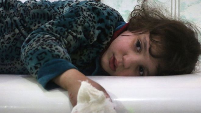طفلة مصابة في الغوطة