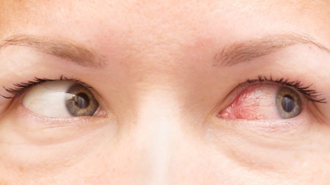 Detalhe do rosto de uma pessoa, mostrando os olhos, sendo o direito vermelho por conjuntivite