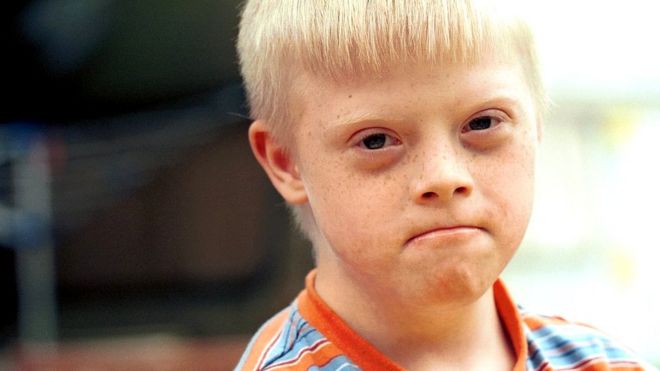 Niño con síndrome de Down.