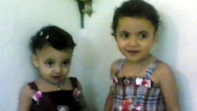 シリアに住むカマルさんとラハフさんは6年前、自宅で空爆に遭い、顔や手に大やけどを負った。カマルさんは9歳になった今も治療を続けている。