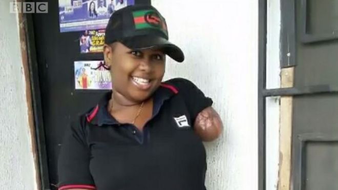 Olivia Malachy cut arm for motor accident on 6 May 2017 for Owerri Eastern Nigeria