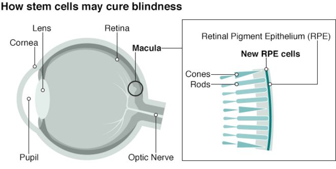 Графика: как стволовые клетки могут вылечить слепоту