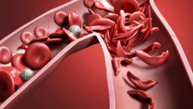 Иллюстрация того, как серповидноклеточная анемия влияет на клетки