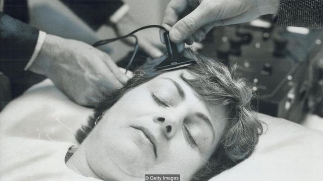 Médicos colocam eletrodos na cabeça de paciente durante simulação de sessão de ECT, em 1976