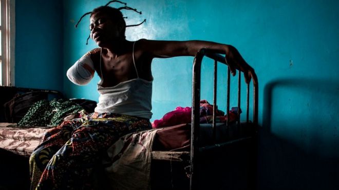 Конголезская женщина, которой ампутировали руку после огнестрельного ранения, сидит на своей кровати 23 октября 2017 года в Чикапе