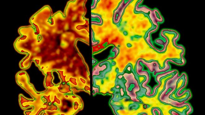 alzheimer's brain scan