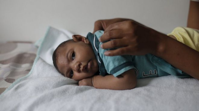 Ребенок с микроцефалией, связанной с вирусом Зика, в Бразилии