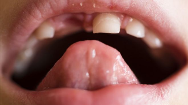Рот с отсутствующими зубами