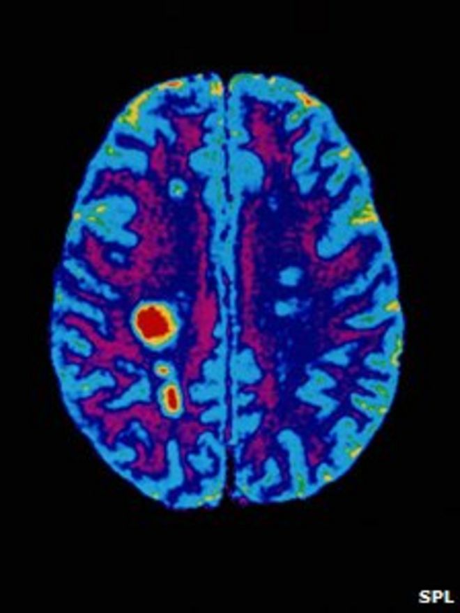 Сканирование мозга пациента с РС