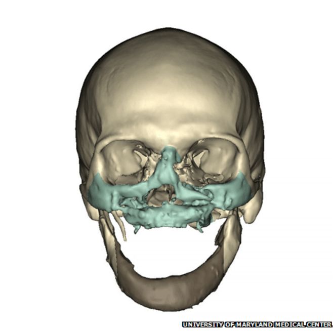КТ перед операцией по пересадке лица (Фото: Медицинский центр Университета Мэриленда)