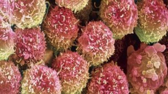 Клетки рака легких, видимые под цветной сканирующей электронной микрофотографией