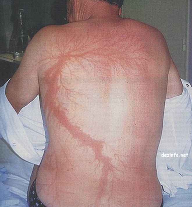 Спина человека с травмами молнии, которые похожи на ветви цветов или деревьев