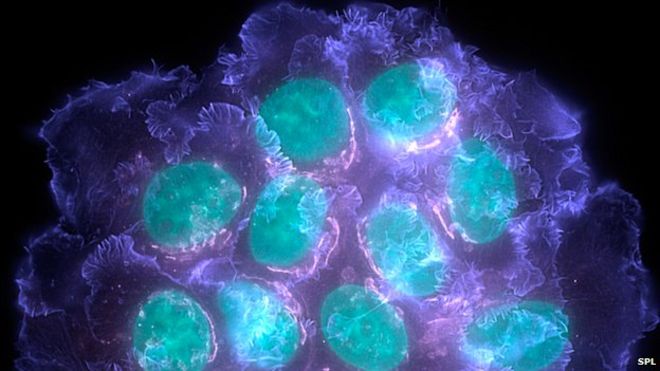 Клетки рака молочной железы