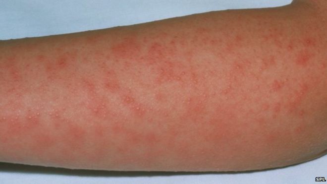 Scarlet Fever Rash