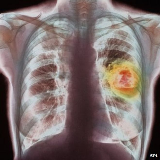 Цветная рентгенография грудной клетки, показывающая рак легких