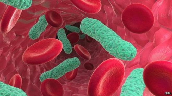 Бактериальная инфекция крови, вызывающая сепсис