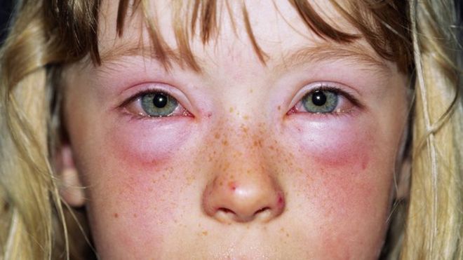 Ребенок с неизвестной аллергией