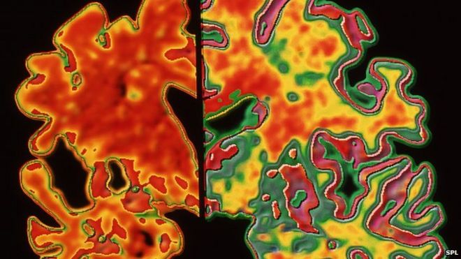 Сканирование изображения мозга, пораженного болезнью Альцгеймера