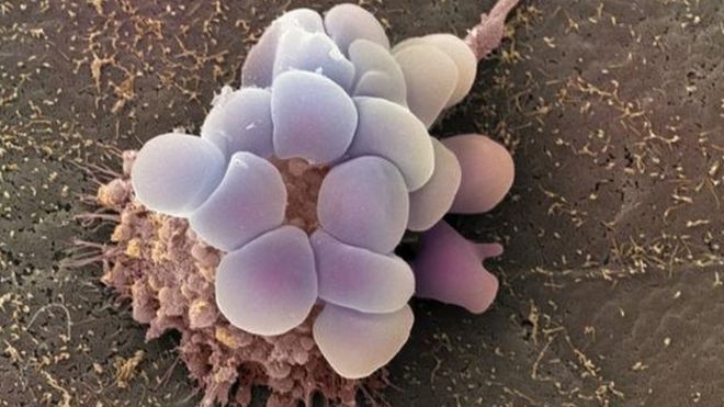 Раковые клетки яичников