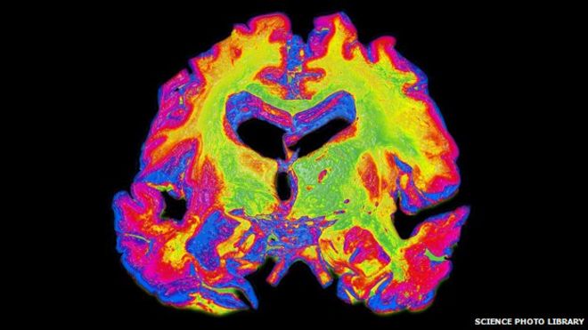 Мозг с тяжелой болезнью Альцгеймера