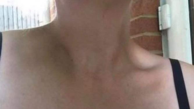 Bruises on the neck