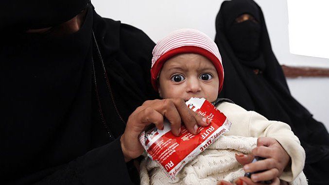 A Yemeni infant suffering from malnutrition waits for treatment at a medical centre in Bani Hawat, on the outskirts of the capital Sanaa, on 9 January 2017
