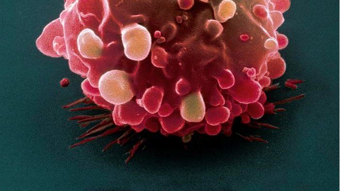 Coloured scanning electron micrograph of an intestinal cancer cell
