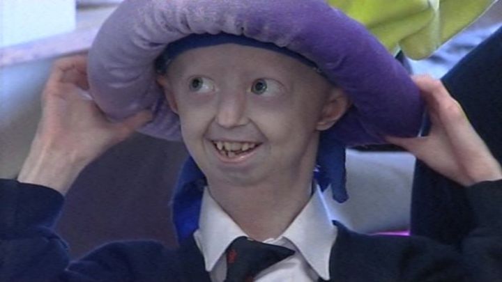 Progeria Campaigner Hayley Okines Dies Aged 17 Bbc News