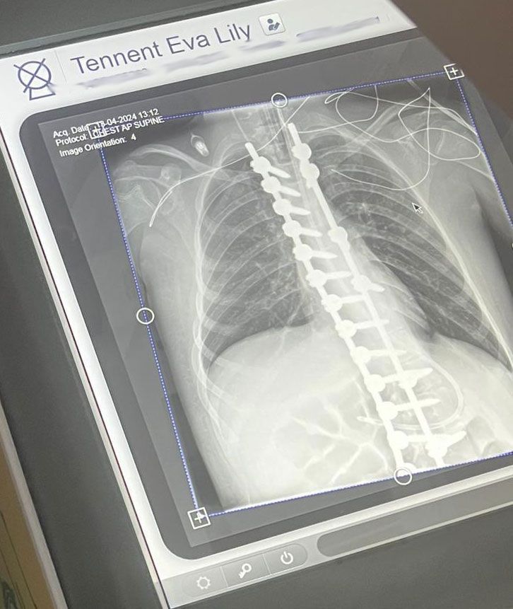 A chest x-ray shows Eva's spine after her surgery