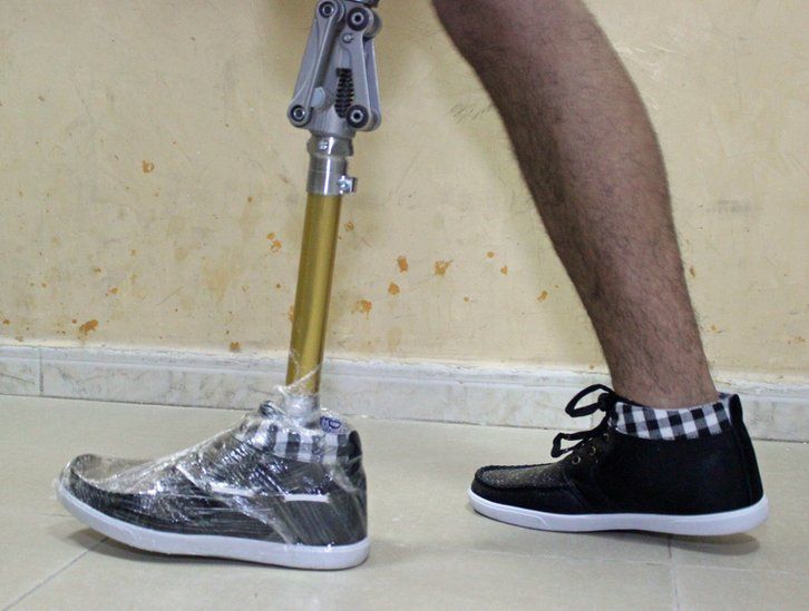 Asem trying on his artificial limb
