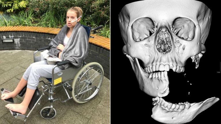 Emily Eccles after the operation, and a CT scan taken beforehand
