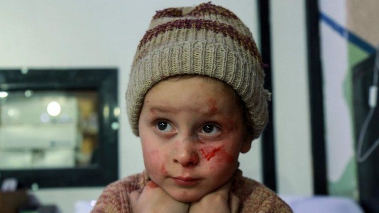 A Syrian child with blood stains from the fighting in the Eastern Ghouta, 3 March 2018