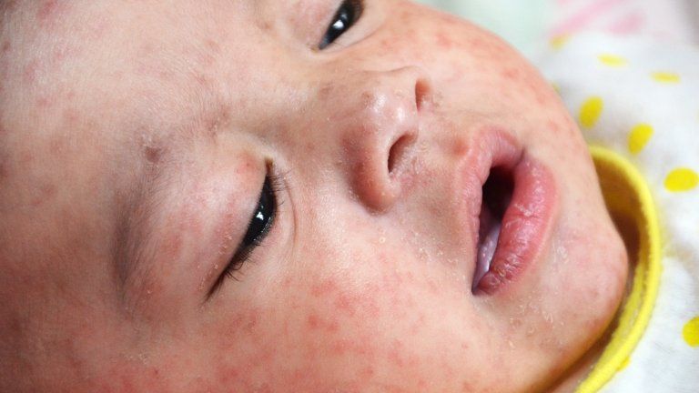 A close-up photograph of a baby with measles