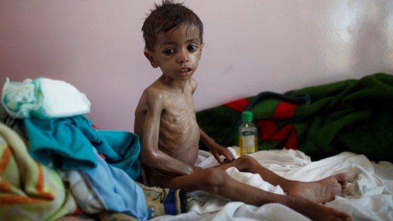 A malnourished boy in Sanaa, Yemen. Archive photo