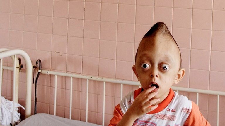 Suffering from suspected effects of Agent Orange, Xuan Minh, three, looks out from his bed at a hospital in Ho Chi Min city in March 2005