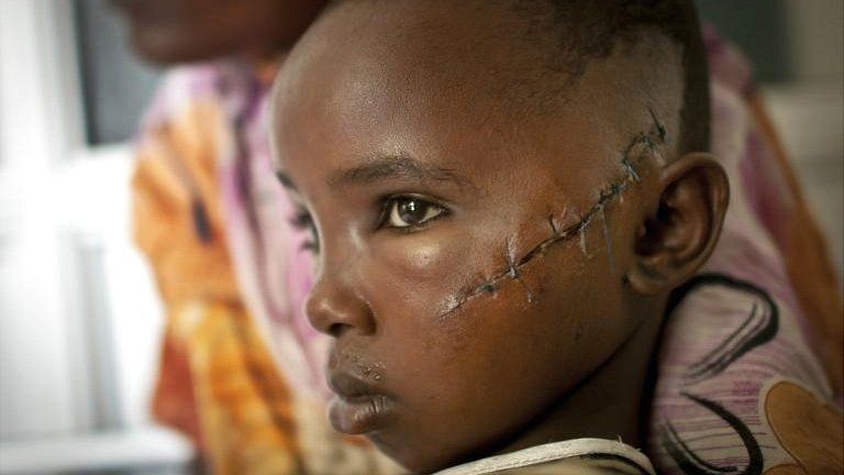 Jamila Yakobo, who was slashed by a machete while she was trying to flee with her father an attack on her village of Kilelengwani at the Tawfiq Hospital in Malindi, Kenya on 14 September 2012