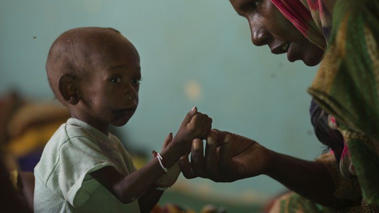 Child being treated for malnutrition at a clinic in Chad