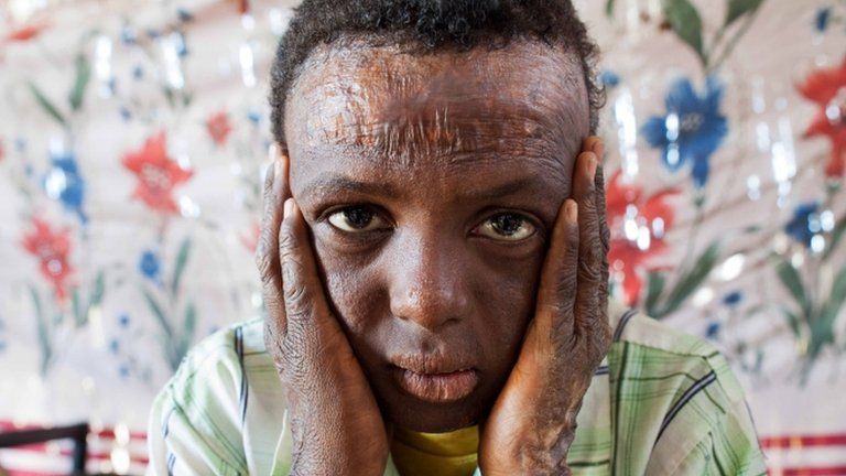 Suleiman Fatul Saim, 10, from Dar al-Salam in North Darfur, posing for a picture in El-Fasher, the administrative capital of North Darfur, on April 2, 2013. Suleiman suffered burns to more than 90 percent of his body when his brother detonated a device found near their house in November 2006