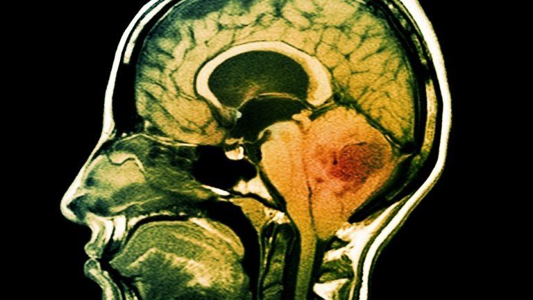 MRI of a brain tumour