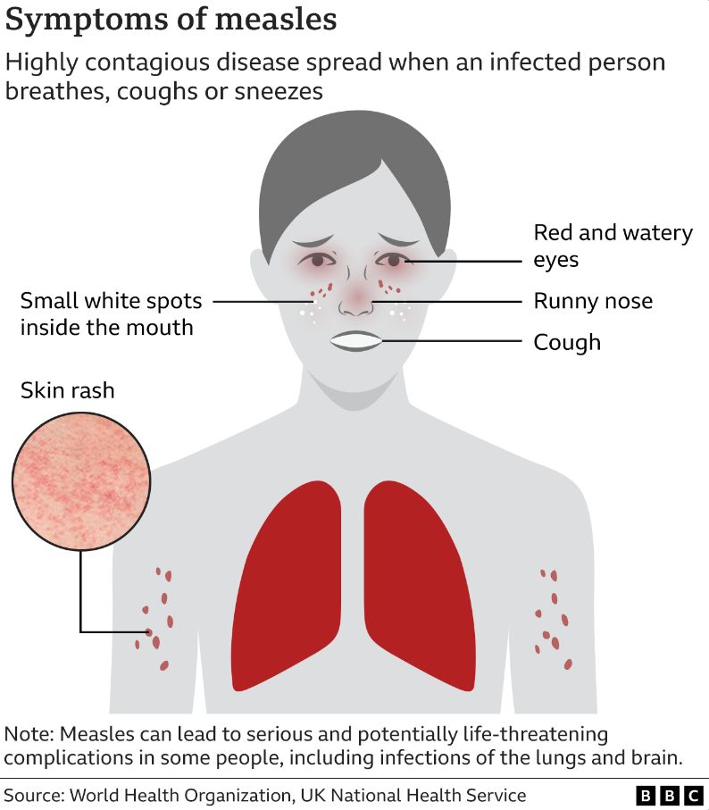 Graphic measles symptoms