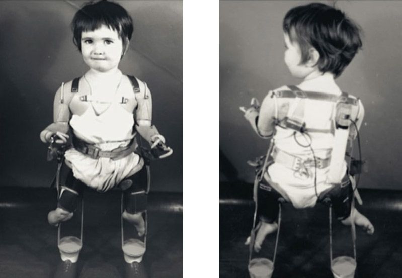 A black and white image of Alison Lapper as a small child wearing artificial legs. There are two pictures, side by side. One is of Alison facing the front and the other, facing the back.