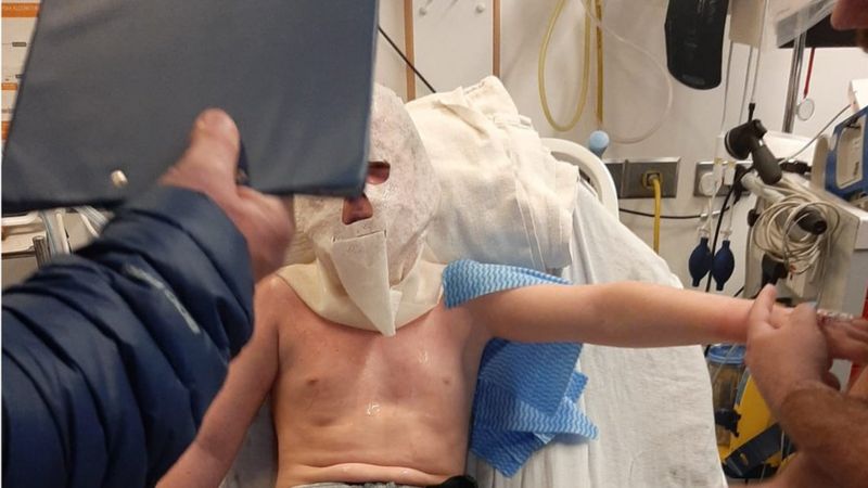 Belfast Boy Burned In Online Copycat Stunt Bbc News 6440