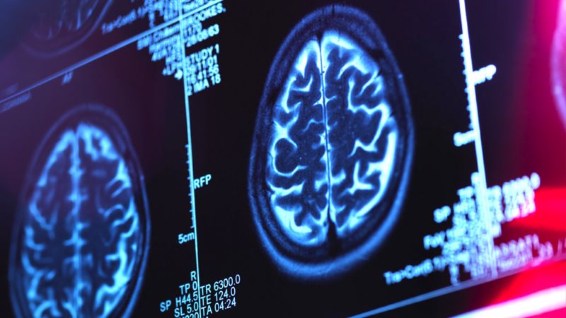 Alzheimer's drug lecanemab hailed as momentous breakthrough - BBC News
