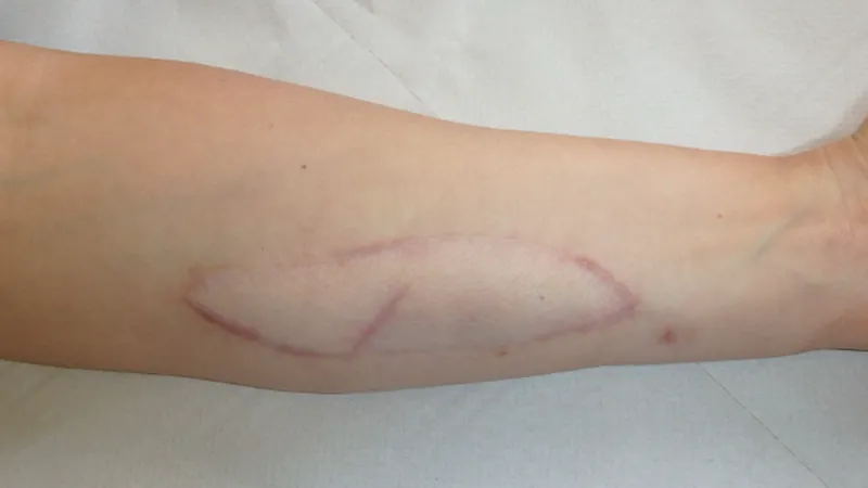 Arm skin patch system could warn of organ rejection