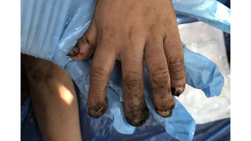Tungíase: como ‘bicho de pé’ faz yanomamis sofrerem amputações e afeta até animais