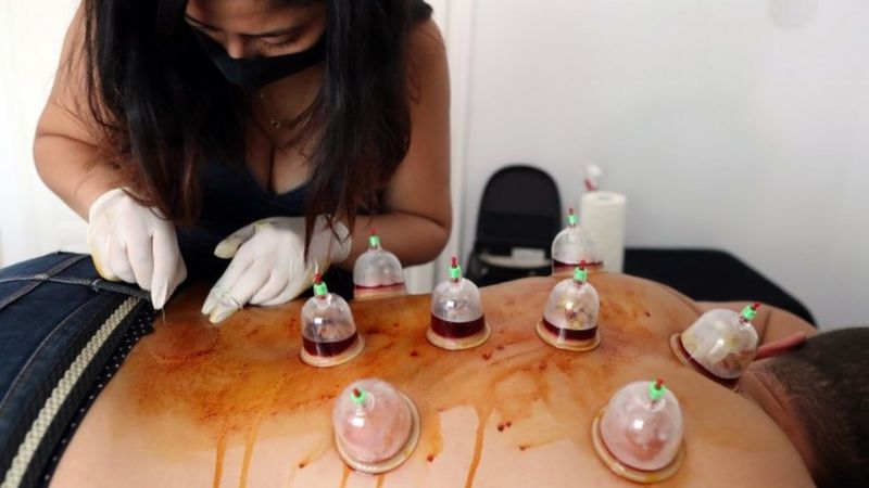 A therapist makes a skin incision on the back of a man undergoing Hijama (wet cupping) therapy inside a treatment room at a physiotherapy center in Tunis, Tunisia, 30 September 2020. Hijama or cupping therapy, is an ancient treatment that uses glass cups and suction to help circulate blood and relieve muscle tension