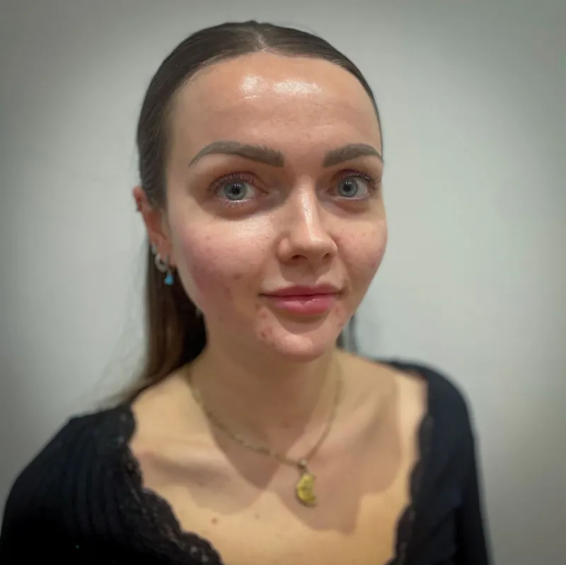 Adiós a los rellenos: te contamos por qué la gente se inyecta semen de pescado en la cara.