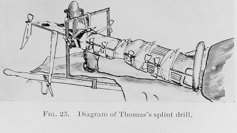 Diagrama de la férula de Thomas