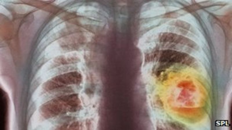 Poor lung cancer care hinders survival, say experts - BBC News